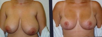 breast reduction before 370460