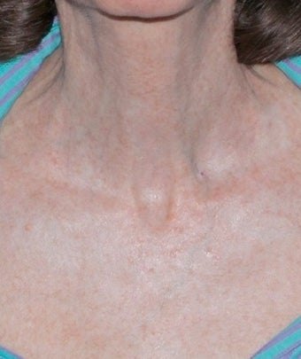 Fractional CO2 Laser Treatment after 374379