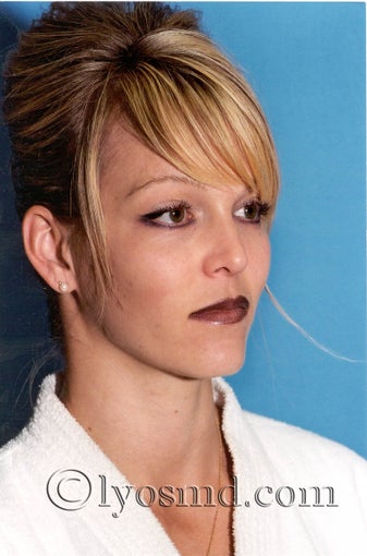 Cheek and Lip Enhancement - Facial Plastic Surgery after 225062