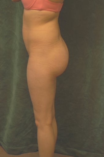 Women's Buttocks Augmentation after 518136