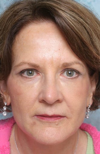 Undereye Deepfill Restylane® and Perioral Perlane® after 119379