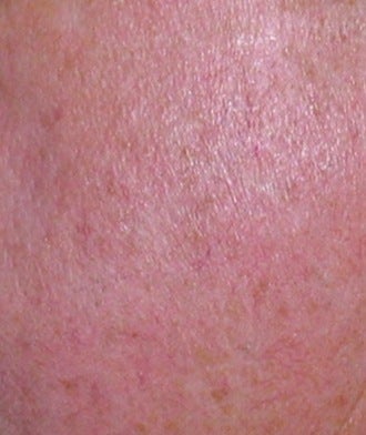 Laser vein treatment after 374353