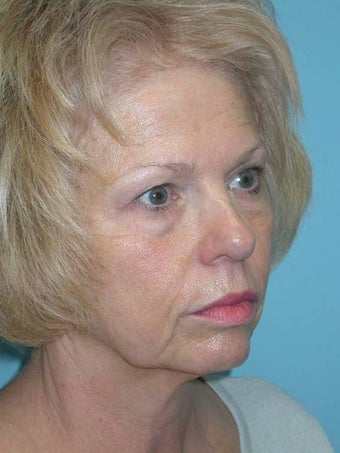 Full Facial Rejuvenation before 148574