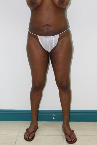 Liposuction and Fat Injection after 526160