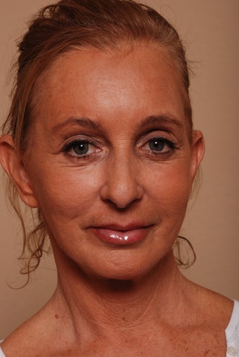 Stem Cell Enriched Facial Rejuvenation after 173285