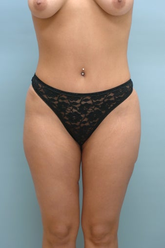Bikini Tummy Tuck after 243642