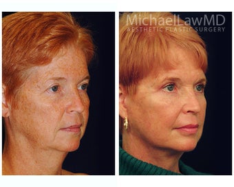 Facial Rejuvenation after 395152