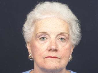 Facial rejuvenation after 140822