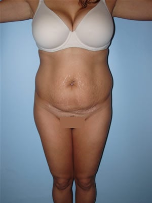Tummy Tuck Surgery (Abdominoplasty) before 159980