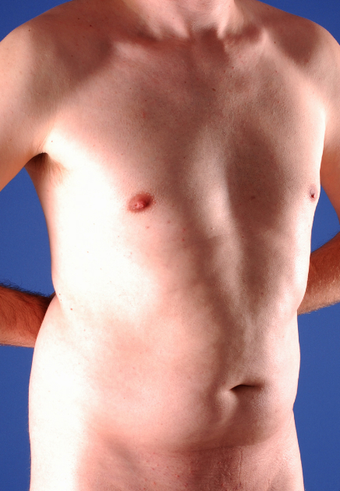 Tummy Liposuction before 229671
