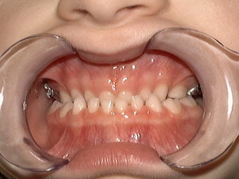 Underbite, Grummons Facemask before 296517