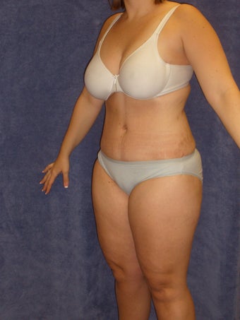 Tummy Tuck with Liposuction 411003