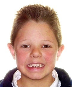 Close Spaces Between Teeth before 344816