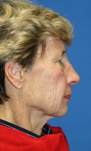 short Incision face lift and chemical peel before 223340
