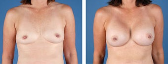 Breast Augmentation before 349398