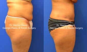 Mini Tummy Tuck after 568398