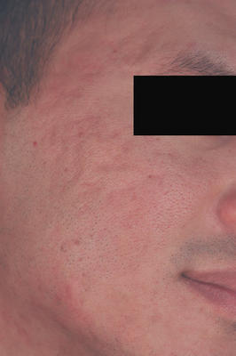 Laser Resurfacing for Acne Scars before 82980