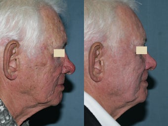 Fraxel repair in conjunction with multiple lasers before 104297