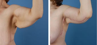 Arm lift (Brachioplasty) before 303698