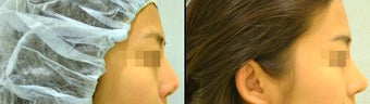 Rhinoplasty before 650752
