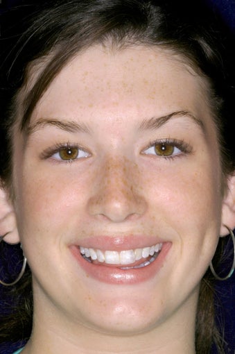 Porcelain Veneers before 399426