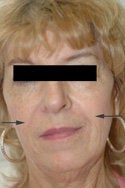 Restylane injections for laugh lines after 91296