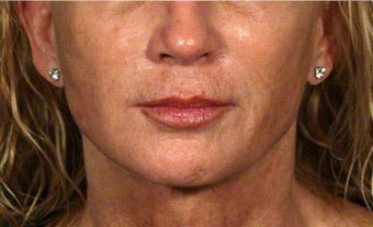 Sculptra, Juvederm, Obagi after 320649