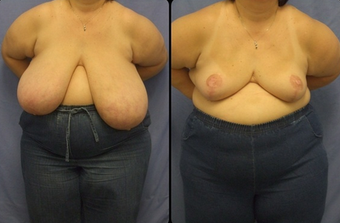 Breast Reduction before 160540