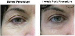 ActiveFX laser treatment for facial lines before 7906