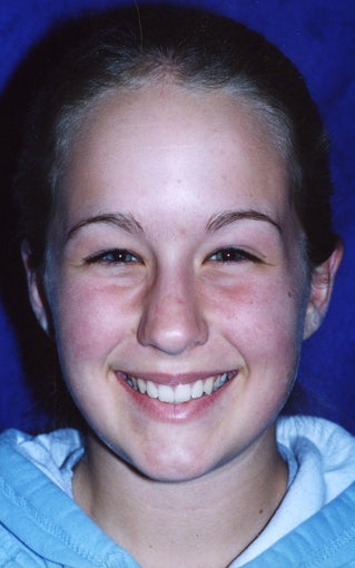 Orthodontic braces to correct a Class II malocclusion 404703