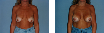 Breast Lift before 265855