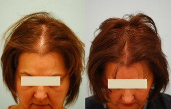 Female Hair Transplant before 133421