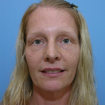 Brow Lift with Upper and Lower Blepharoplasty before 553455