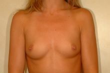Breast Augmentation before 74764