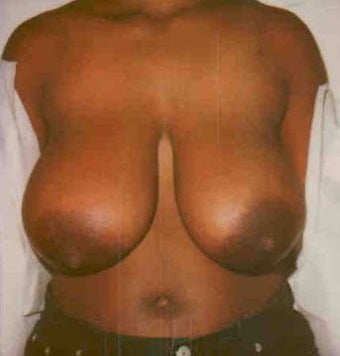 Breast Reduction before 167171