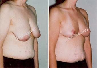 Mastopexy-Breast Lift before 243710