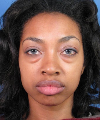 Eyelid Lift Blepharoplasty before 406010