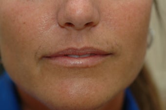 Perma Facial Implant before 340186