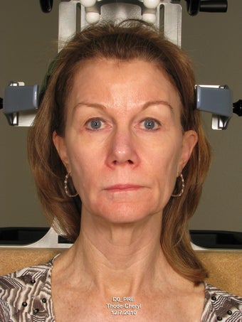Ulthera and Sculptra before 559271