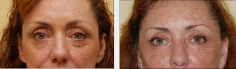 Blepharoplasty before 314261