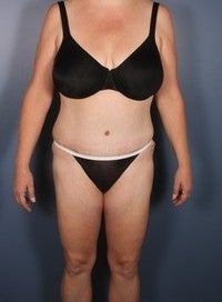 Tummy Tuck, Liposuction after 374144