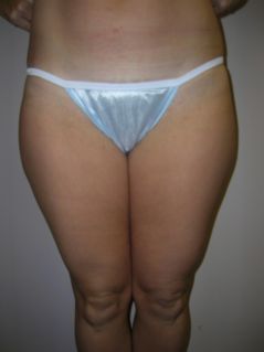 Liposuction before 258650