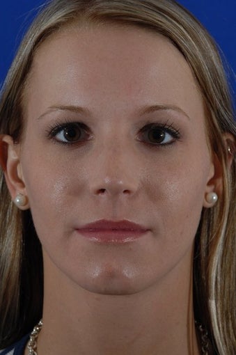 rhinoplasty after 274193