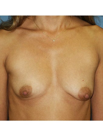Bilateral perioareolar subpectoral breast augmentation with placement of 400cc high profile saline breast implants inflated to 4 before 249959