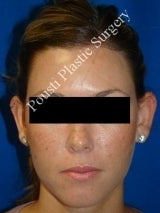 Ear Surgery (Otoplasty) 616517