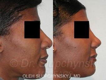 African American Rhinoplasty after 374017