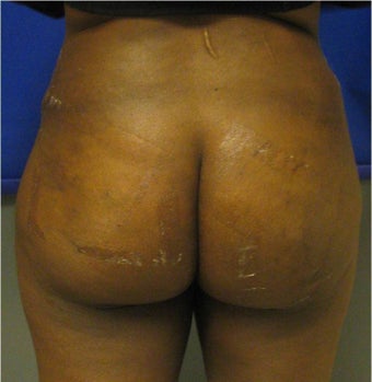Brazilian Buttock Lift after 302922