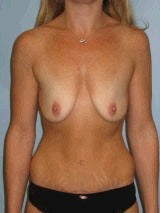 Breast Augmentation before 417444