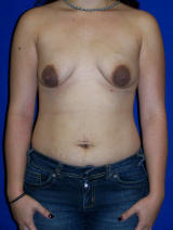 Breast Augmentation with a Benelli Lift before 124936