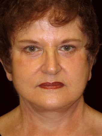 Complete faclift after 247360